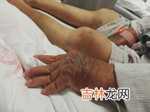 类风湿关节炎吃什么食物,类风湿关节炎吃什么好 这个一定要知道