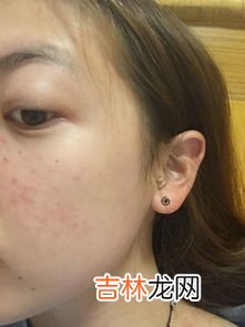 脸上长红痘怎么办,脸上有红痘痘该怎么办
