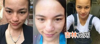 想要斑点迅速消失需要注意哪几点,怎么样可以让脸上的雀斑快速消失