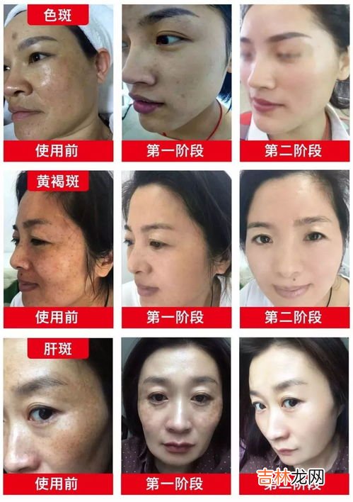 想要斑点迅速消失需要注意哪几点,怎么样可以让脸上的雀斑快速消失