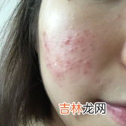 脸上痘印怎么去除,脸上痘印怎么快速去掉 6个小妙招让你轻松祛除痘印