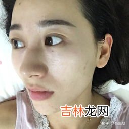 脸上痘印怎么去除,脸上痘印怎么快速去掉 6个小妙招让你轻松祛除痘印