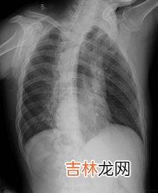 肋骨骨折怎么办,肋骨骨折怎么办