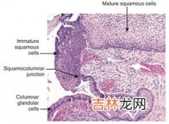 年龄多大需要做宫颈癌筛查,女性多大年龄应该开始做宫颈癌筛查