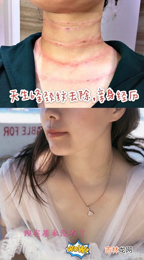 颈纹怎么去除,颈纹怎么消除小巧妙