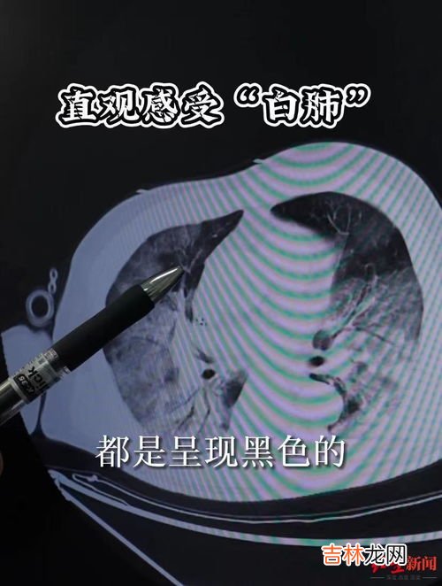 有肺炎就是白肺吗,肺炎白肺是什么意思