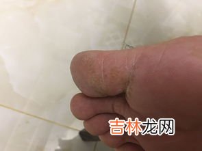 脚气明显可以怎么治疗,脚气如何治疗？