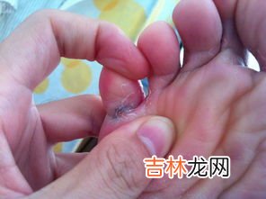 脚气明显可以怎么治疗,脚气如何治疗？