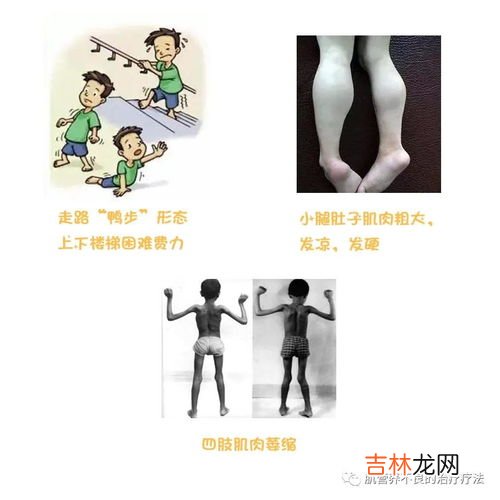 肌营养不良症的预防,如何预防进行性肌营养不良?