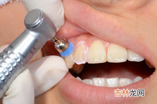 烟渍牙可以洗牙洗掉吗,如何去除牙齿上的烟渍?