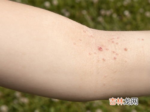 转阴后还有传染性吗,乙肝转阴后还会传染吗