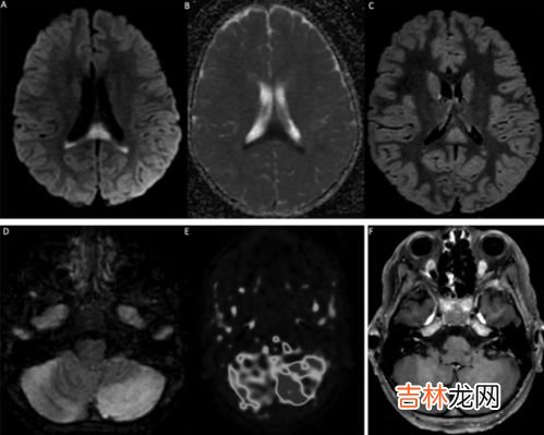 感染新冠病毒后怎么样才算康复,感染了新冠,多久可以康复呀?