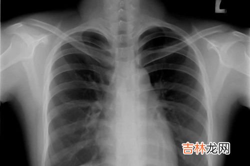 哪些情况需要做肺部CT,咳嗽多久需要拍肺部CT吗?