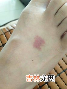 脚上长了冻疮怎么好,脚上长了冻疮怎么好