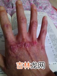 脚上长了冻疮怎么好,脚上长了冻疮怎么好