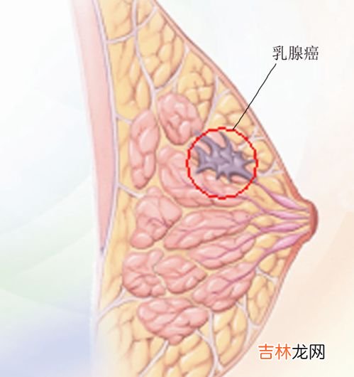 肌腺症症状有哪些,子宫腺肌症的常见症状表现有哪些？