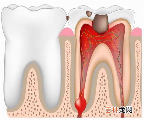 杀死神经的牙为什么还会疼,杀过牙神经的牙齿还会疼吗