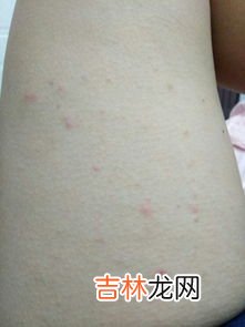 为什么一到夜晚症状就开始加重,阳了之后，为什么一到夜晚症状就加重？