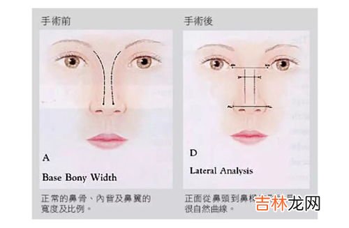如何才可以解决水泥鼻,水泥封鼻孔阶段了是什么阶段