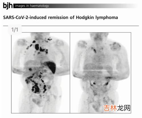 新冠感染初愈后可以大吃大喝吗,新冠患者康复后有哪些注意事项？