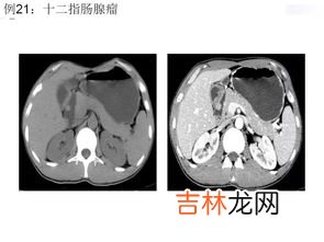 多地肺部CT检查需求激增有必要吗,关于常规体检有必要做胸肺部ct吗