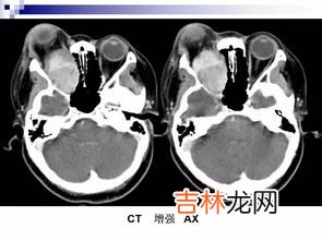 多地肺部CT检查需求激增有必要吗,关于常规体检有必要做胸肺部ct吗