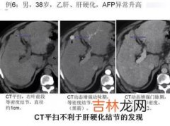 多地肺部CT检查需求激增有必要吗,关于常规体检有必要做胸肺部ct吗