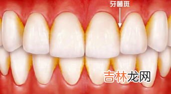 怎样治疗牙菌斑,牙菌斑如何去除?牙菌斑怎么形成的?