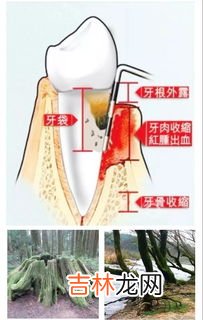 怎样治疗牙菌斑,牙菌斑如何去除?牙菌斑怎么形成的?
