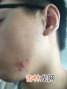 脸上长痘痘如何消除,脸上长痘痘怎么快速去除？