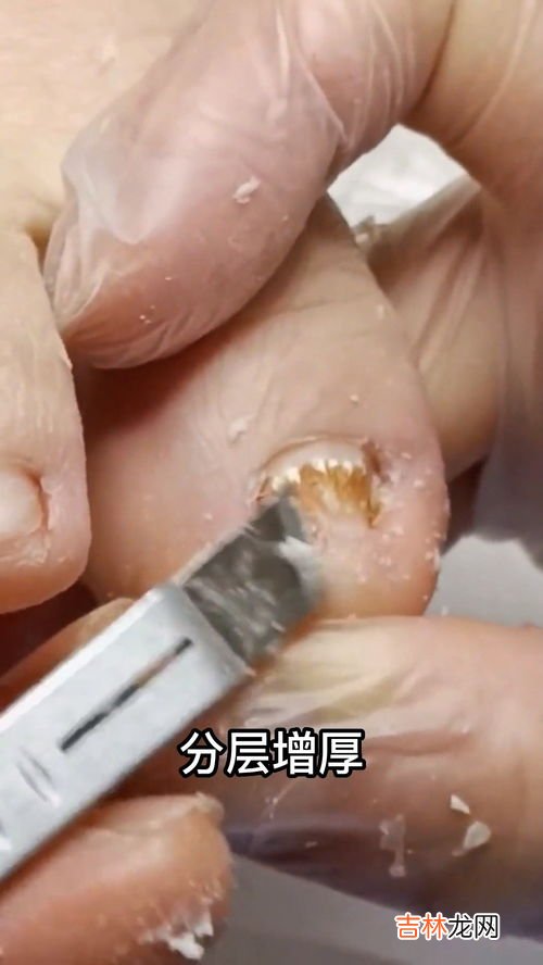 蜂毒怎么解,蜂毒怎么解?