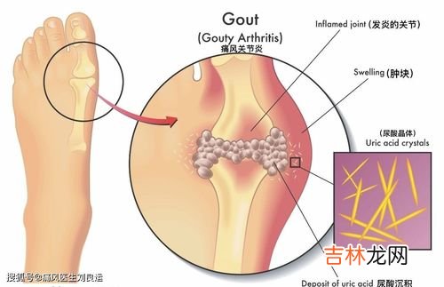娜莎痛风药的副作用,娜莎痛风药成分 娜莎痛风药安全吗?