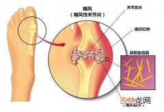 娜莎痛风药的副作用,娜莎痛风药成分 娜莎痛风药安全吗？