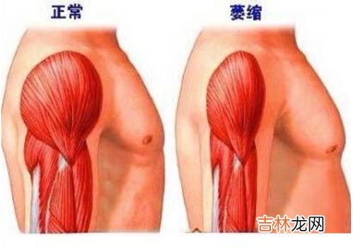健骼宁起什么作用的,老人骨质疏松，医生开的药副作用有点大，食物方面老人胃口不好很多不能吃，有什么可以替代的吗？