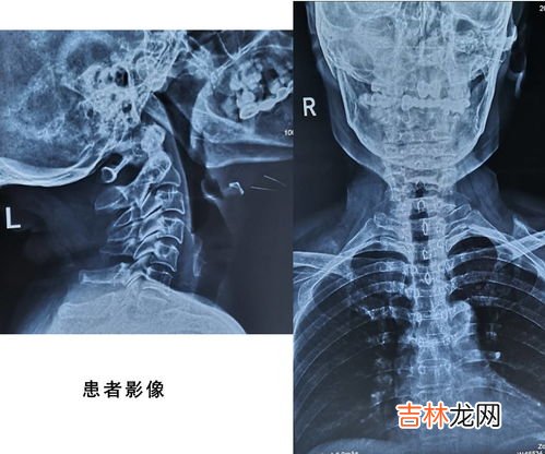 健骼宁起什么作用的,老人骨质疏松，医生开的药副作用有点大，食物方面老人胃口不好很多不能吃，有什么可以替代的吗？