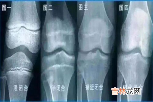 利普高素可以长高吗,我们家长都不高，对孩子的身高发育有点焦虑，医生说吃乐高素，对长高有用吗？