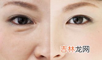 如何去掉眼底皱纹,去眼部皱纹的小妙招