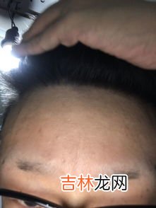 美人尖是什么,美人尖是什么_美人尖的面相学