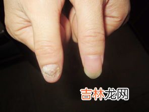如何鉴别灰指甲严重程度,如何判断灰指甲？