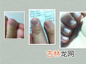 如何鉴别灰指甲严重程度,如何判断灰指甲？