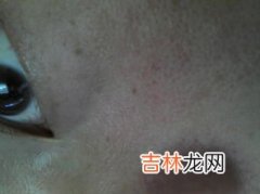 夏天脸上毛孔粗大怎么办,脸上毛孔粗大怎么办 4个生活收缩毛孔小妙招