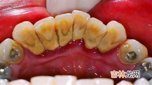 牙齿松动怎么办,牙齿松动了怎么办