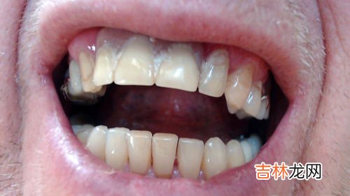 牙齿松动怎么办,牙齿松动了怎么办