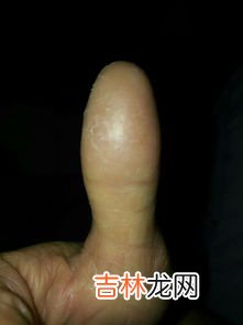 鹅掌风的症状及治疗,手上皮肤病,鹅掌风,怎么能治好?
