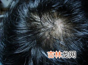 哪些方法可以减少脱发,怎样减轻掉头发 怎样才能缓解掉头发