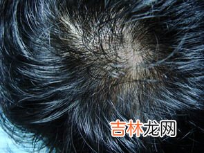 哪些方法可以减少脱发,怎样减轻掉头发 怎样才能缓解掉头发