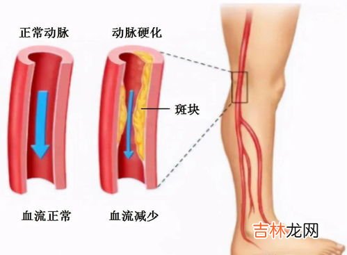 参七通络茶治疗脂肪瘤吗,脂肪瘤怎么治疗？