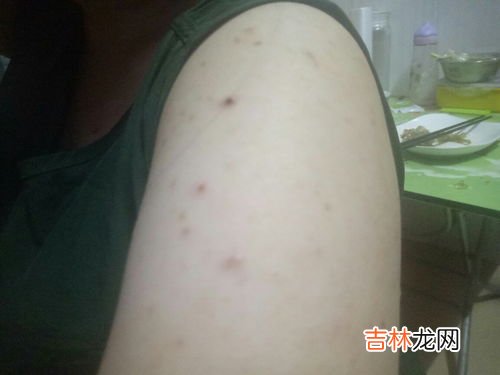 为什么后背会长痘痘,后背长痘痘是什么原因_背长痘痘是什么原因导致的