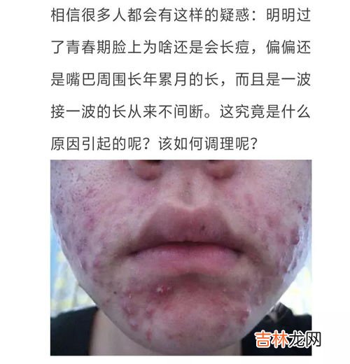 脖子长痘痘是什么原因,脖子上长痘痘是怎么回事？