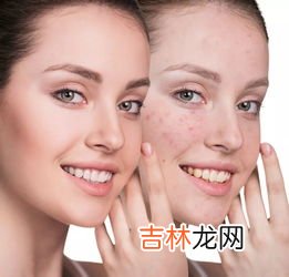 脸上长痘痘是什么原因,脸上长了痘痘是什么原因